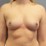Breast Augmentation Before & After Patient #6919