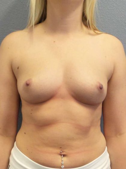 Breast Augmentation Before & After Patient #6919