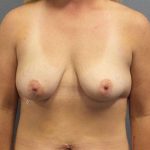 Breast Lift with Implant (Augmentation Mastopexy) Before & After Patient #4531