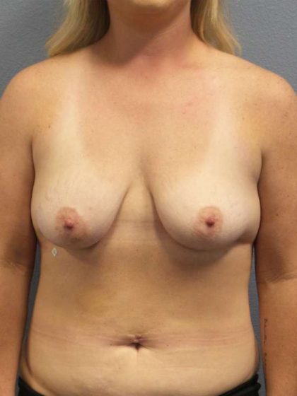 Breast Lift with Implant (Augmentation Mastopexy) Before & After Patient #4531