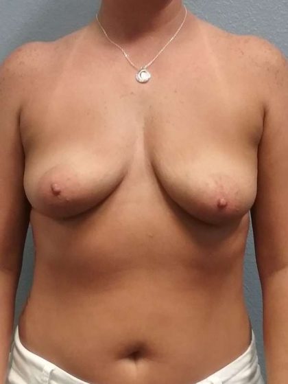 Asymmetric (Uneven) Breasts Before & After Patient #6865