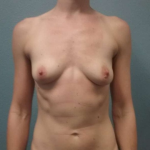 Breast Augmentation Before & After Patient #6676