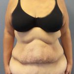 High BMI (Larger Patients) Surgery Before & After Patient #10393
