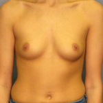 Breast Augmentation Before & After Patient #11562