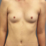 Breast Augmentation Before & After Patient #6760