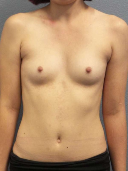 Breast Augmentation Before & After Patient #6760