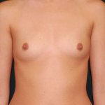 Breast Augmentation Before & After Patient #6578