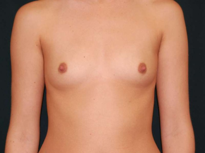 Breast Augmentation Before & After Patient #6578