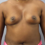 Breast Augmentation Before & After Patient #11436