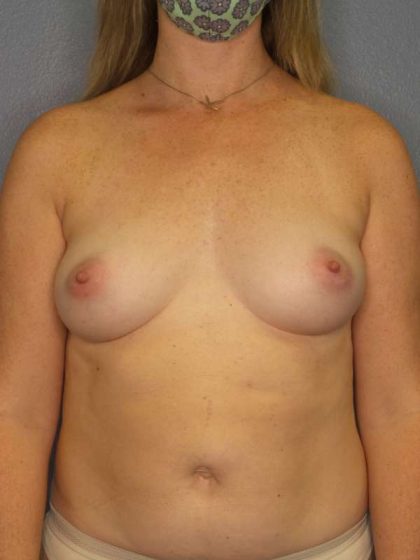 Breast Augmentation Before & After Patient #6364