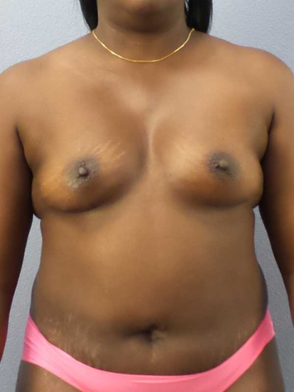 Breast Augmentation Before & After Patient #11436