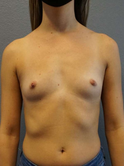 Breast Augmentation Before & After Patient #6457