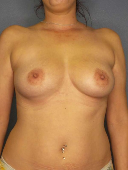 Breast Augmentation Before & After Patient #6348