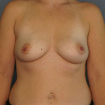 Breast Augmentation Before & After Patient #6153