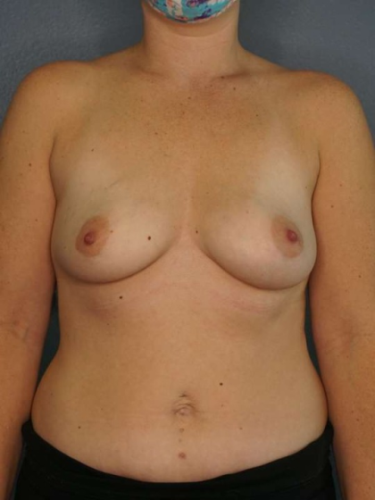 Breast Augmentation Before & After Patient #6153