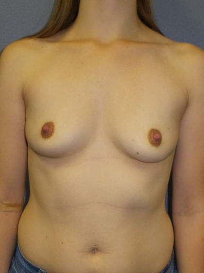 Breast Augmentation Before & After Patient #5860