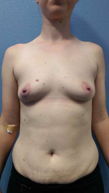 Breast Augmentation Before & After Patient #5706