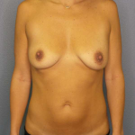 Breast Augmentation Before & After Patient #5422