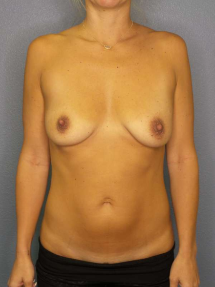Breast Augmentation Before & After Patient #5422