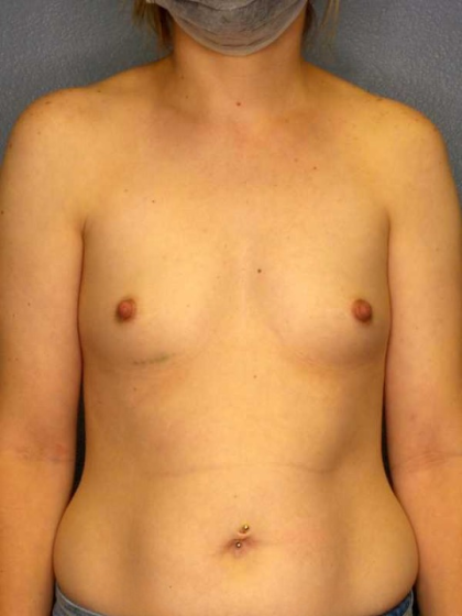 Breast Augmentation Before & After Patient #11573