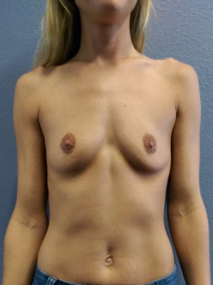 Breast Augmentation Revision (Breast Enlargement Repair) Before & After Patient #7396