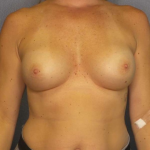 Breast Augmentation Revision (Breast Enlargement Repair) Before & After Patient #7212