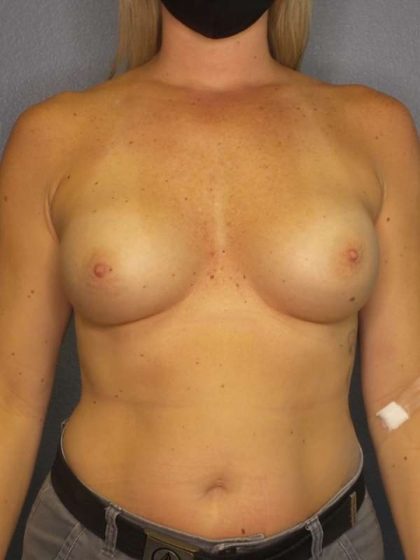 Breast Augmentation Revision (Breast Enlargement Repair) Before & After Patient #7212