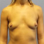 Breast Augmentation Before & After Patient #5357