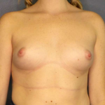 Breast Augmentation Before & After Patient #6993