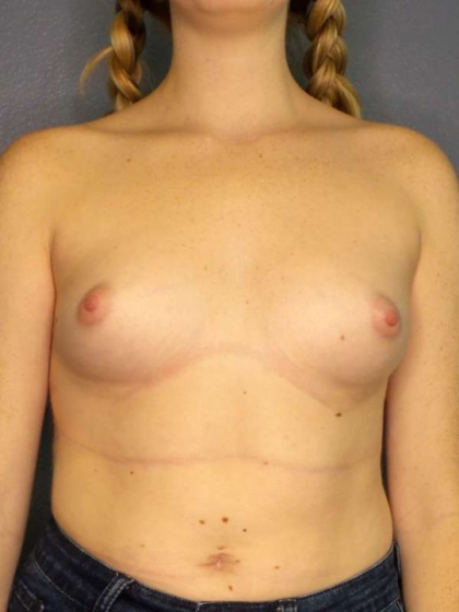 Breast Augmentation Before & After Patient #6993