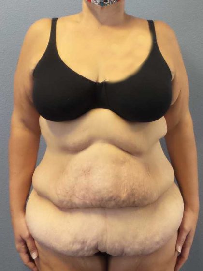 High BMI (Larger Patients) Surgery Before & After Patient #10393