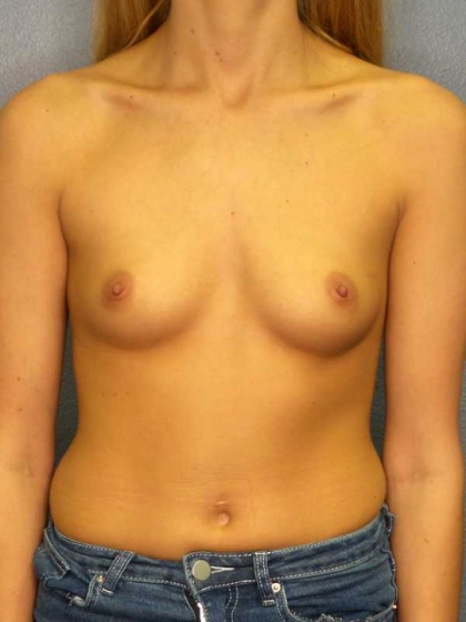 Breast Augmentation Before & After Patient #11562