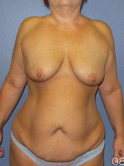 Breast Lift with Implant (Augmentation Mastopexy) Before & After Patient #4013