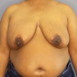Mastopexy (Breast Lift) Before & After Patient #8402