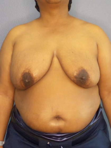 Mastopexy (Breast Lift) Before & After Patient #8402