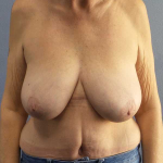 Mastopexy (Breast Lift) Before & After Patient #8377