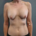 Breast Augmentation Revision (Breast Enlargement Repair) Before & After Patient #7260