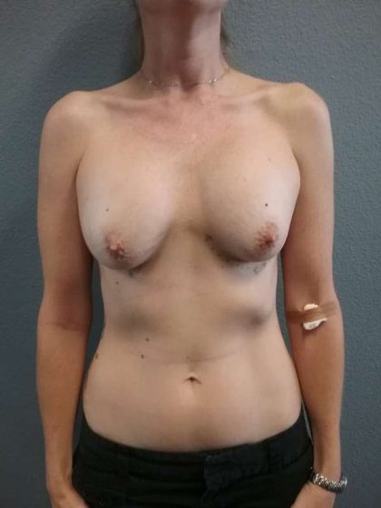 Breast Augmentation Revision (Breast Enlargement Repair) Before & After Patient #7260