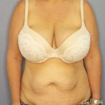 High BMI (Larger Patients) Surgery Before & After Patient #10438