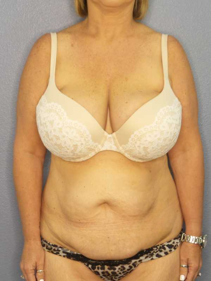 High BMI (Larger Patients) Surgery Before & After Patient #10438