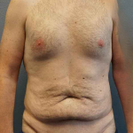 Male Liposuction Before & After Patient #3808