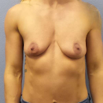 Breast Augmentation Before & After Patient #6589