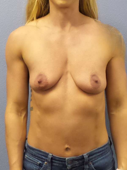 Breast Augmentation Before & After Patient #6589