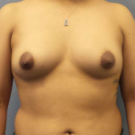 Breast Augmentation Before & After Patient #5626