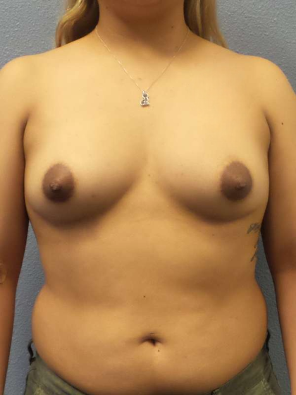 Breast Augmentation Before & After Patient #5626