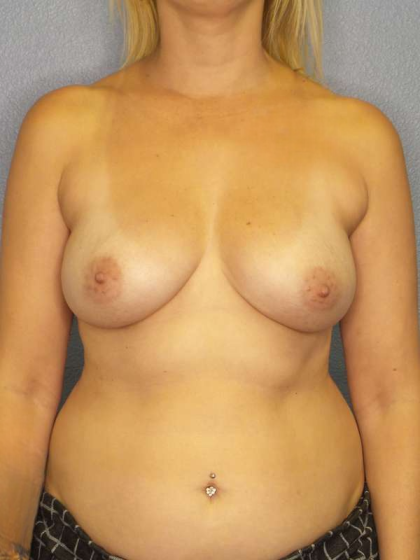 Breast Augmentation Before & After Patient #5502
