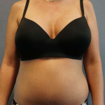Liposuction Female Before & After Patient #8101