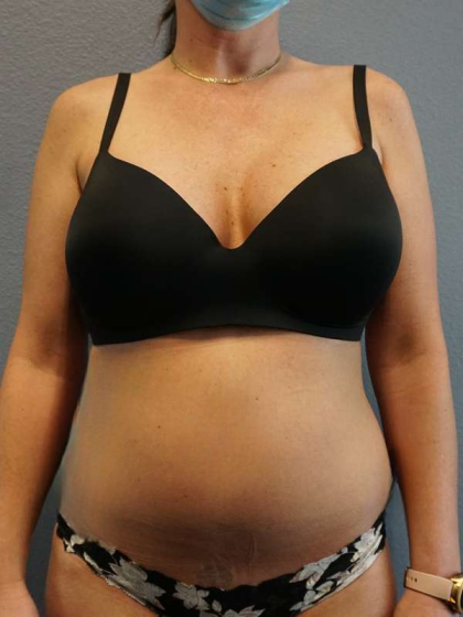 Liposuction Female Before & After Patient #8101