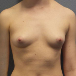 Breast Augmentation Before & After Patient #5296