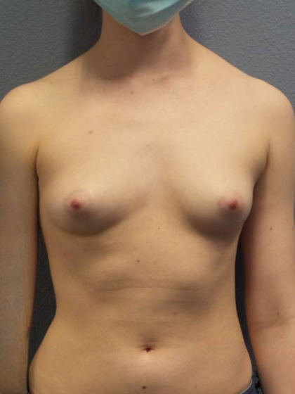 Breast Augmentation Before & After Patient #5296